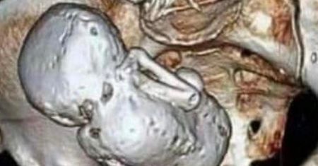 Skarżyła się a ból brzucha. W jej ciele znaleziono "kamienne dziecko"