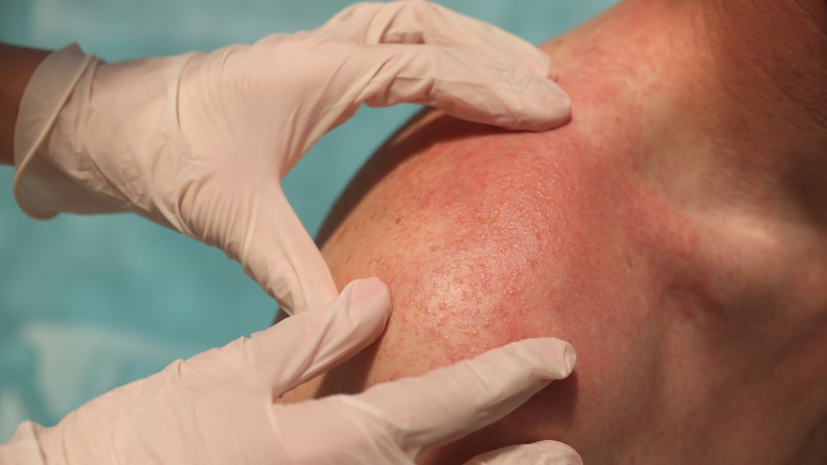 15-latka zmaga się z niezwykle rzadką alergią 