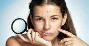 Trądzik hormonalny – podpowiadamy, jak z nim walczyć