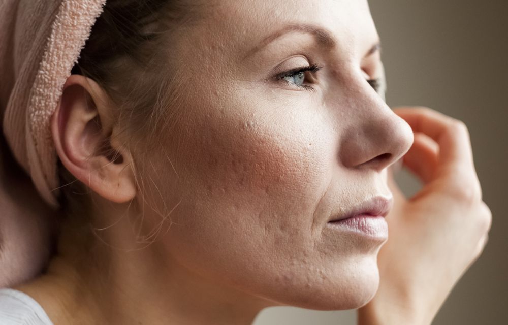 Problematyczny trądzik grudkowy. Co go powoduje i jak sobie z nim radzić?