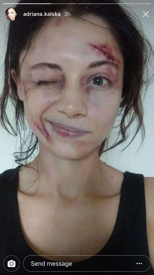 Adriana Kalska ma zmasakrowaną twarz