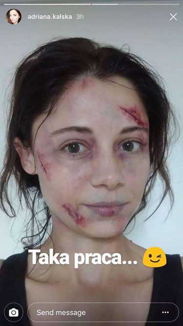Adriana Kalska ma zmasakrowaną twarz