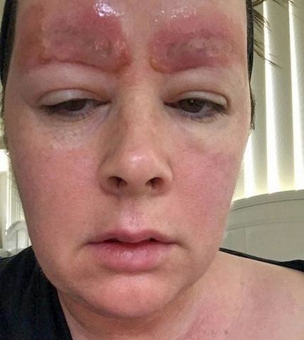 Kobieta doznała uszkodzenia podczas zwykłego zabiegu makijażu permanentnego