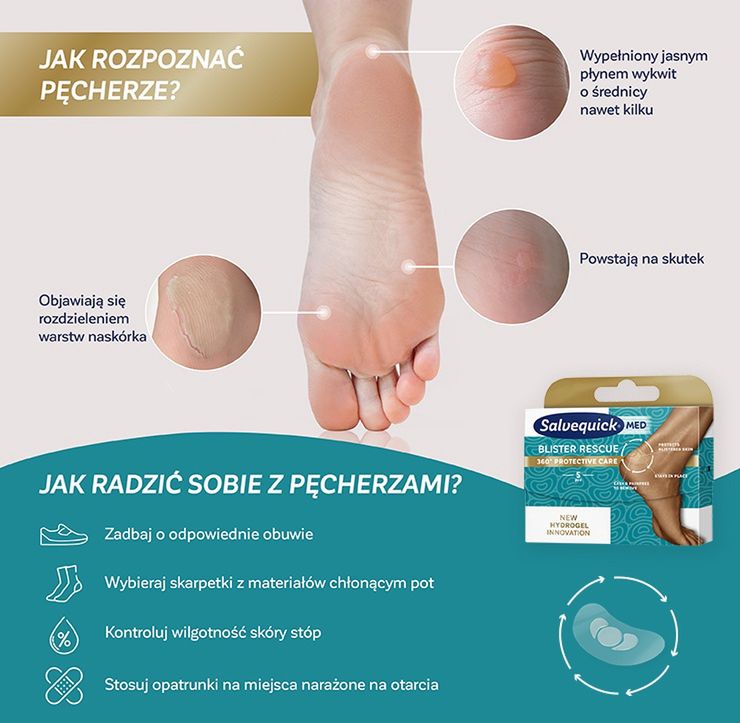 pęcherze – jak rozpoznać i jak sobie z nimi radzić