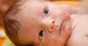Wysypka u dziecka - alergia, choroby, infekcje