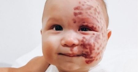 Miał gigantyczne znamię. Na mamę spadł hejt, bo chciała je usunąć