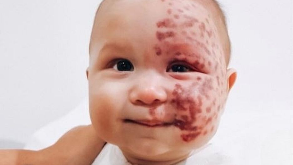 Urodził się z ogromnym znamieniem na twarzy