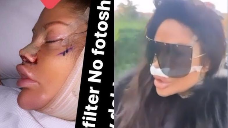 Laluna Unique chwali się efektami operacji w tureckiej klinice