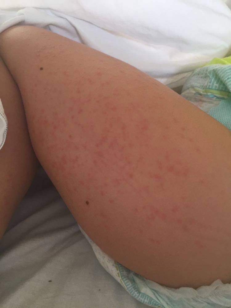 Wysypka na ciele - to kolejny objaw Kawasakiego