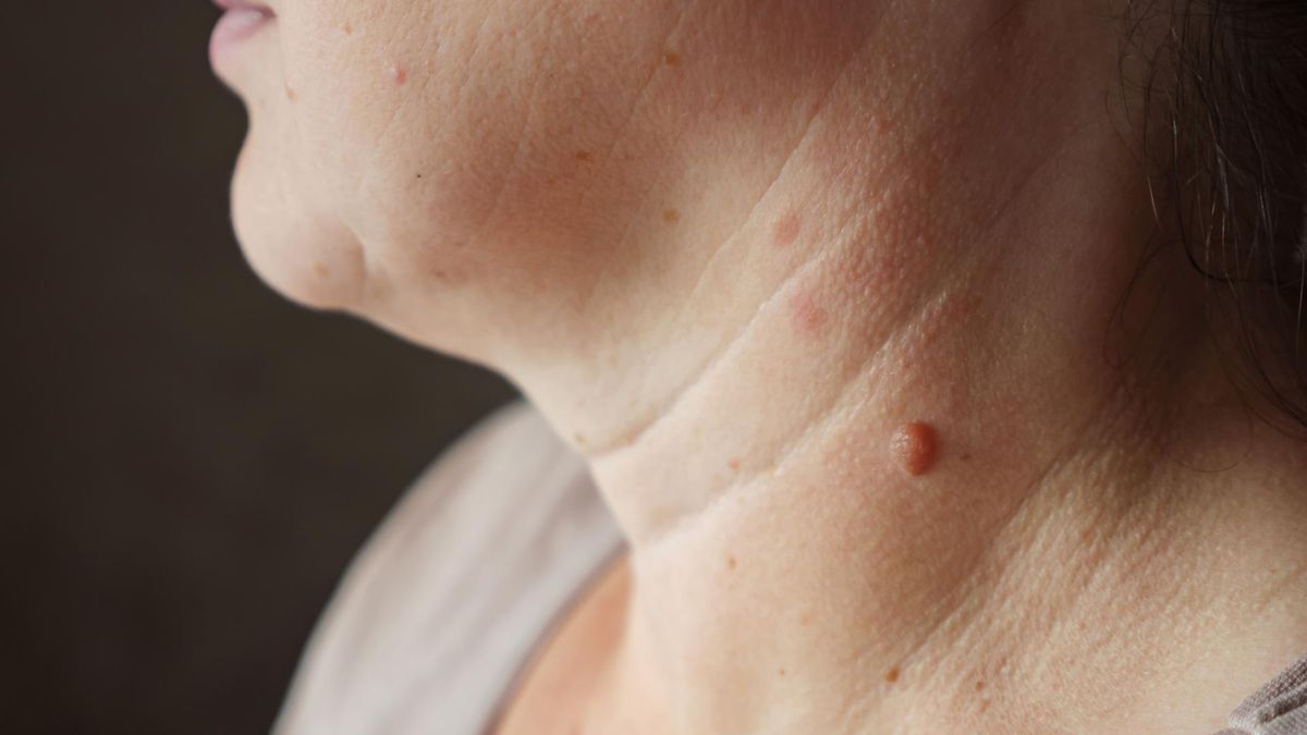 Przybywa pacjentów z nowotworami skóry. W Polsce dwie choroby przed czerniakiem