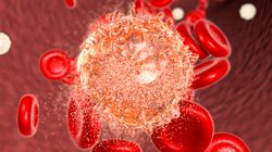 Diagnostyka ostrej białaczki limfoblastycznej