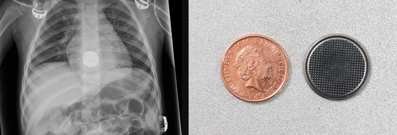 Prześwietlenie wykazało baterię w przełyku dziecka. Co robić, gdy dziecko połknie baterię?