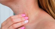 Wysypka na szyi – przyczyny, objawy i leczenie