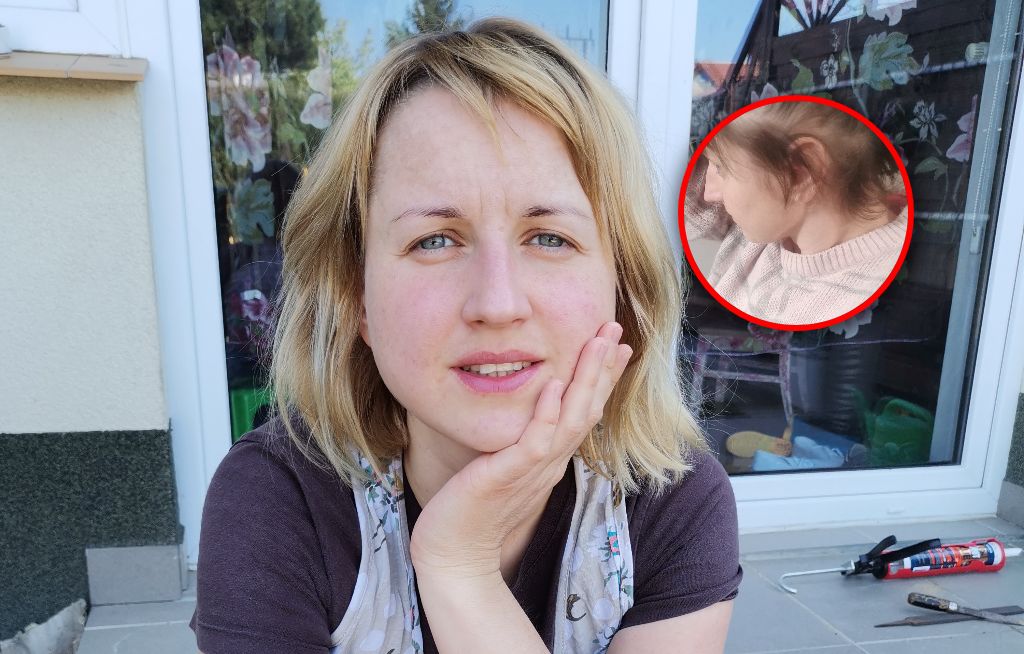 Laura od 27 lat wyrywa sobie włosy z głowy. "W akcie rozpaczy ogoliłam się na łyso"