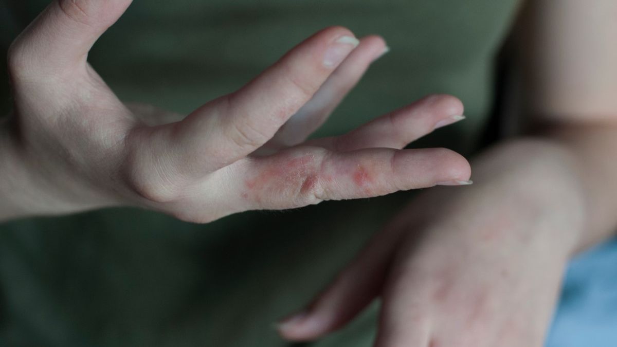 Świerzbowiec ludzki to kosmopolityczne roztocze z gatunku Sarcoptes scabiei varietas hominis. Wywołuje on chorobę zwaną świerzbem.