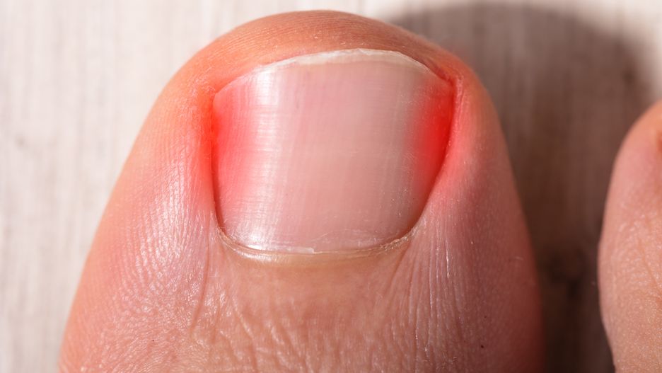 Sposób na wrastające paznokcie