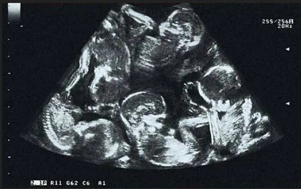 Wiadomość o pięcioraczkach była szokiem