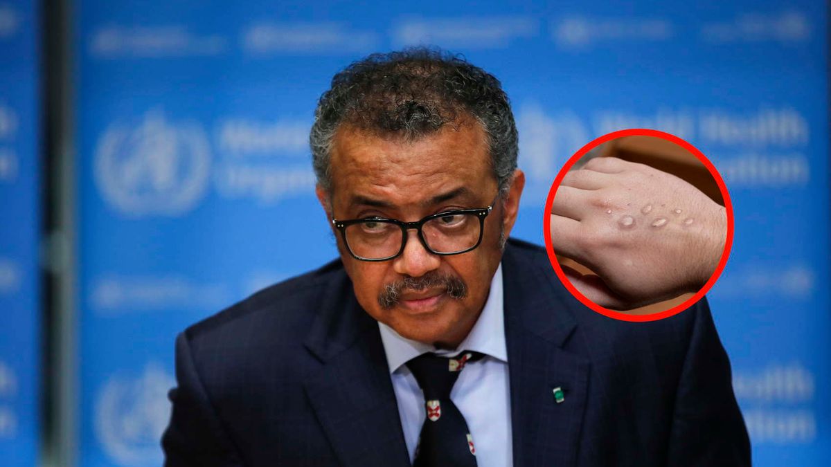 WHO nie wyklucza stanu zagrożenia. Powodem wirus małpiej ospy