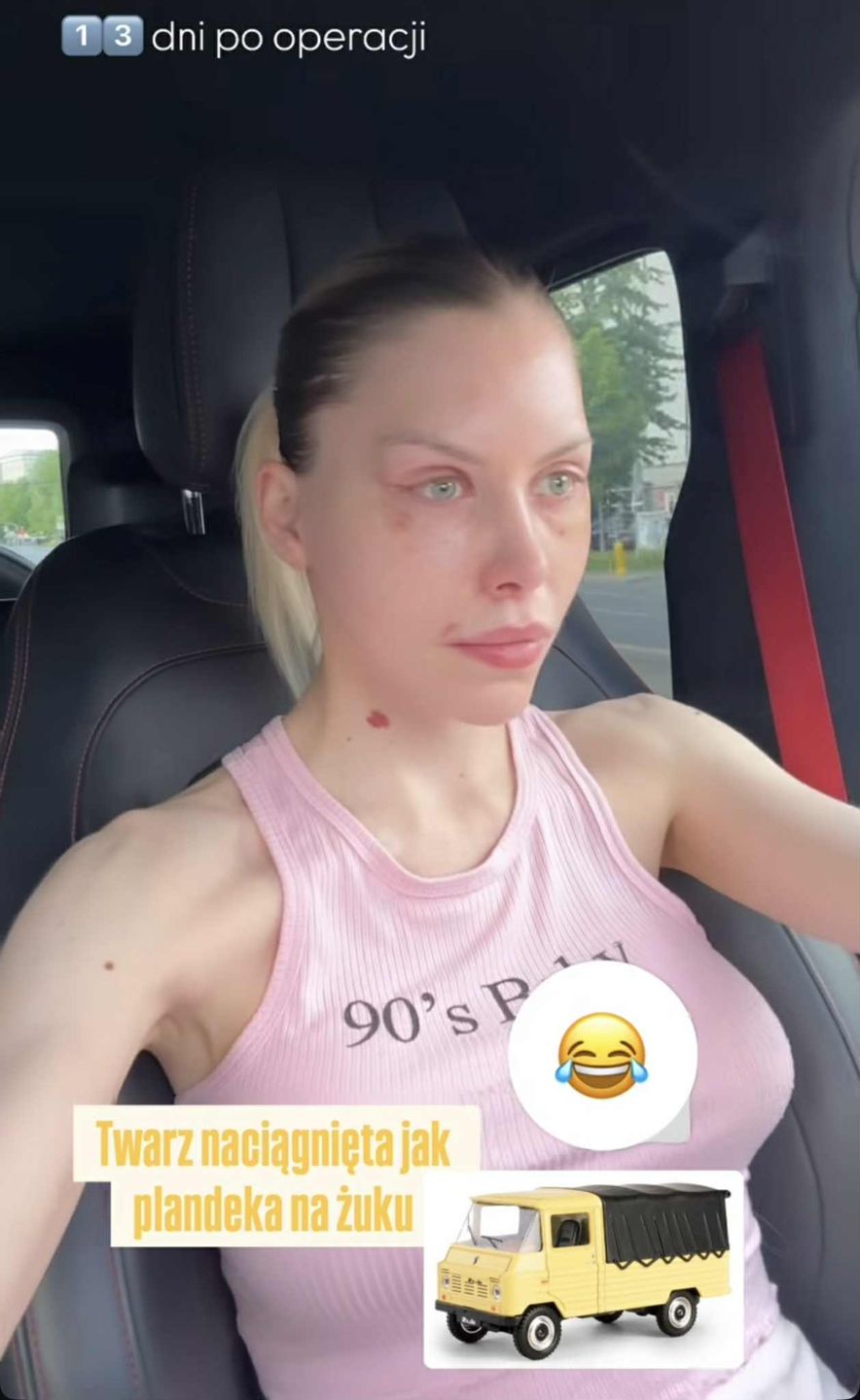 Julia von Stein pokazała zliftingowaną twarz 13 dni po operacji