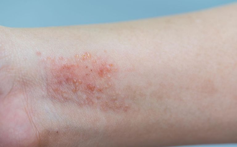 Czym jest atopowe zapalenie skóry ?