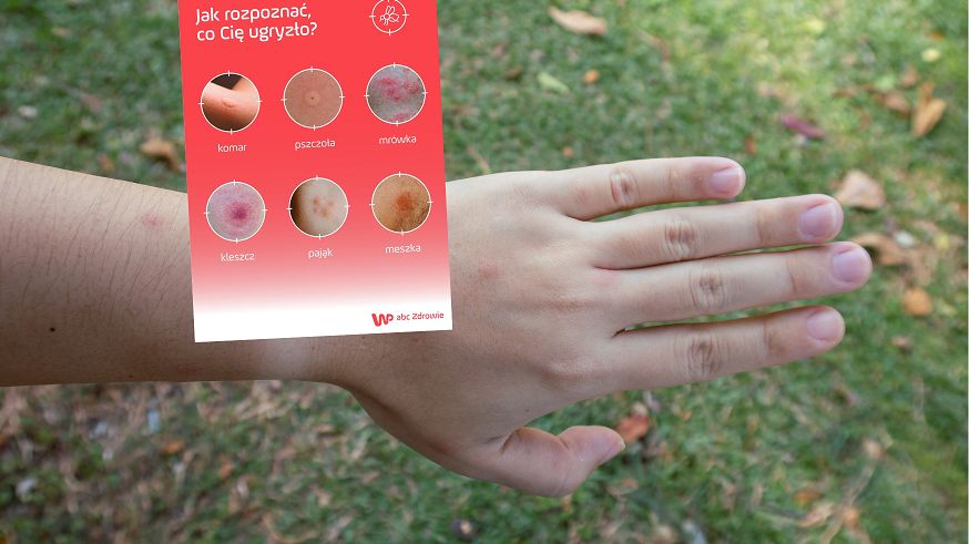 Krótki przewodnik po ukąszeniach owadów. Sprawdź, co cię ugryzło