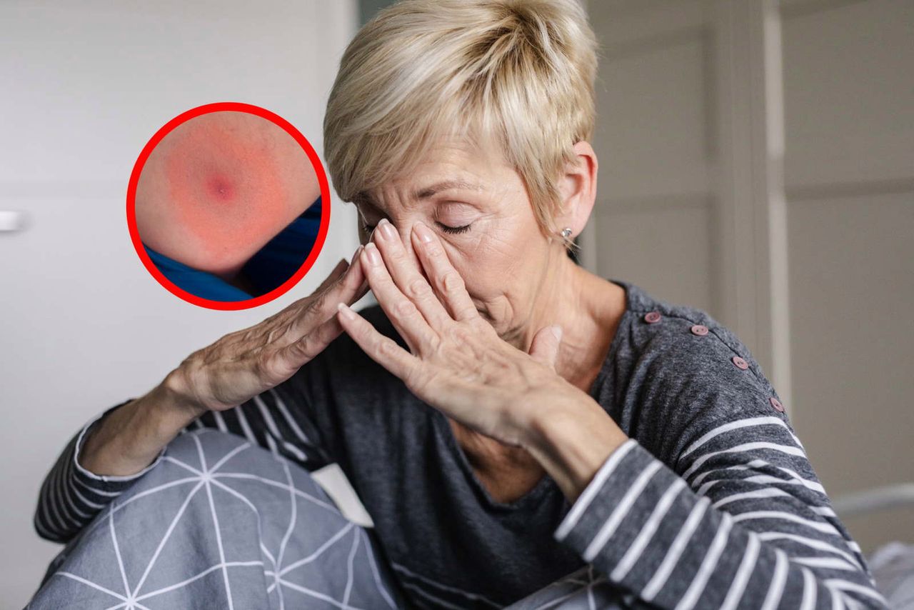 Gwałtowny wzrost przypadków boreliozy i KZM. Lekarze wskazują przyczyny