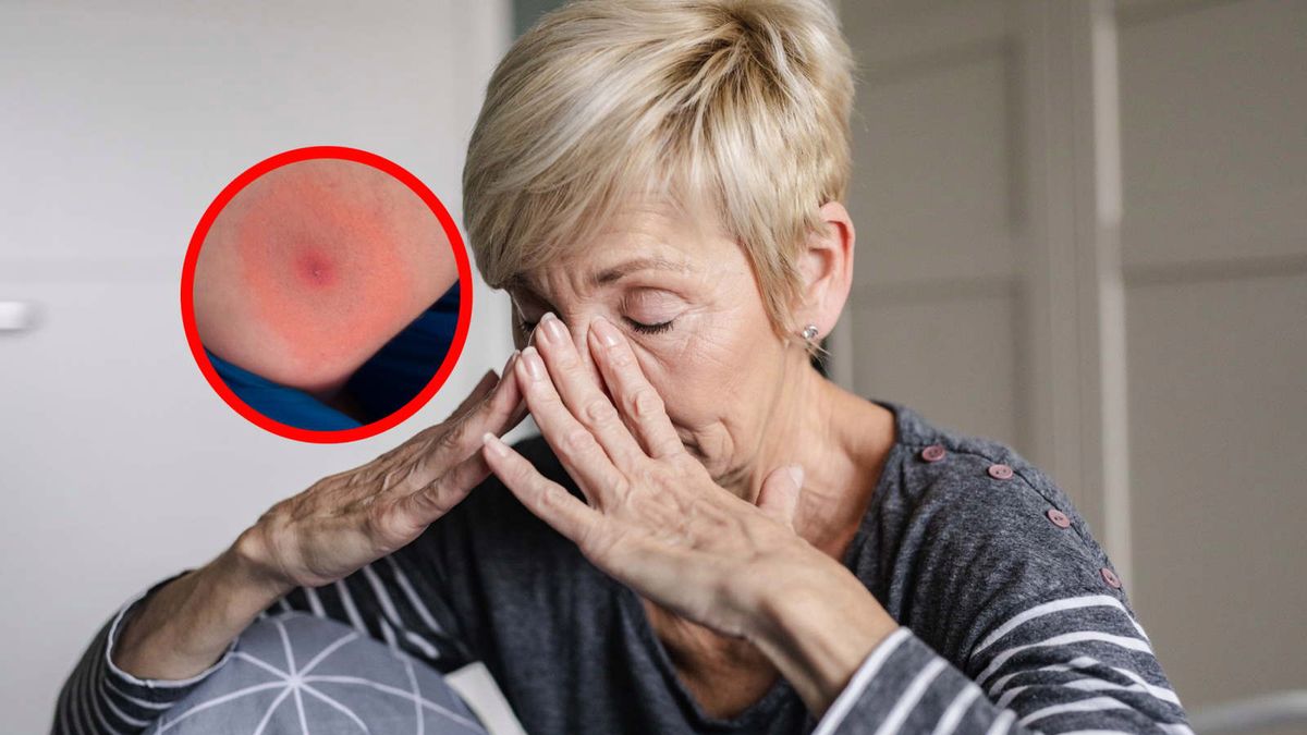 Przybywa Polaków cierpiących na choroby odkleszczowe. "Pacjenci nie odzyskują pełnej sprawności"