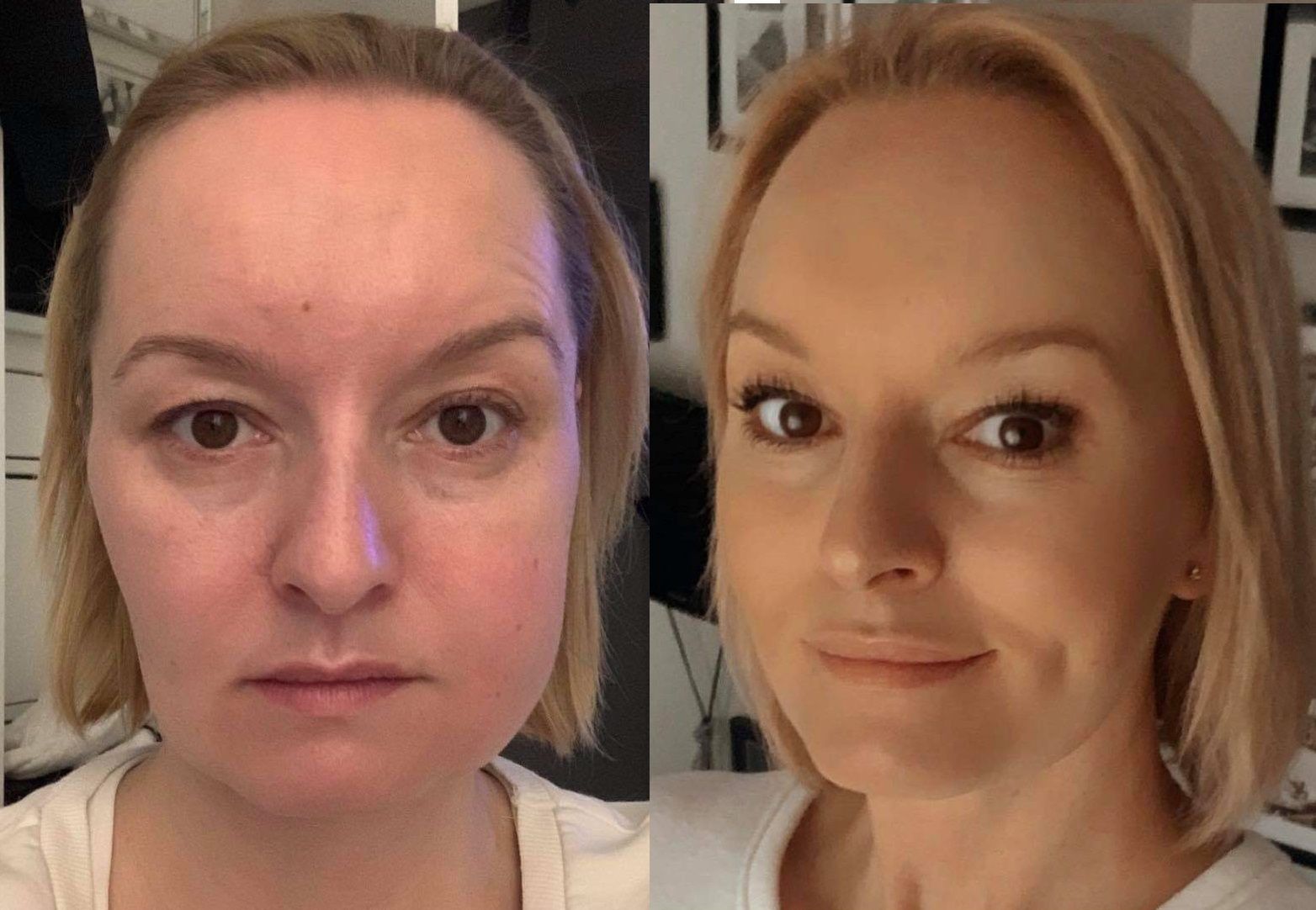 Na zdjęciu widać, jak twarz Agnieszki zmieniła na skutek komplikacji po wyrwaniu ósemki