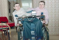 Bliźniaczki syjamskie z ZSRR. Masza i Dasza zostały okaleczone przez lekarzy