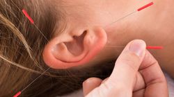 Leczenie akupunkturą