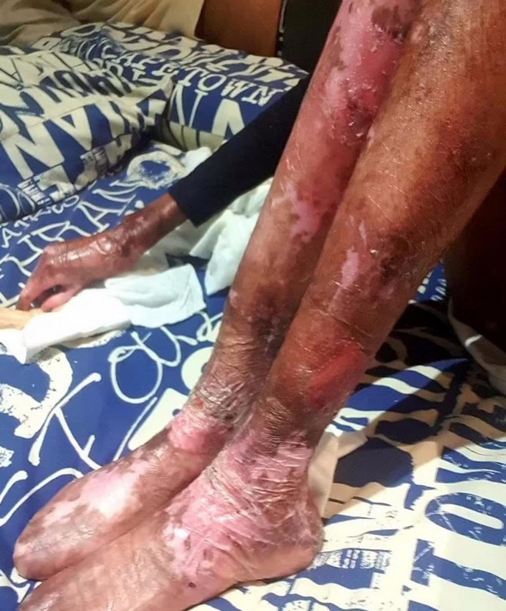 Choroba powoduje u niej występowanie pęcherzy i ran