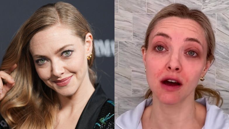 Amanda Seyfried pokazała, jak radzi sobie z egzemą