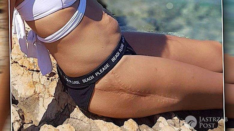 Blizna na ciele MAi Hyży