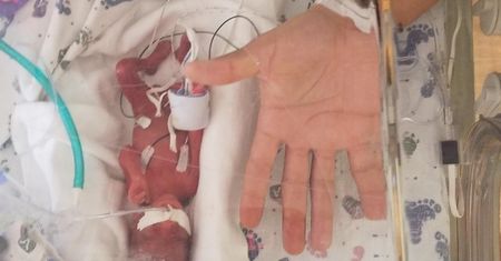 Dziecko przyszło na świat 4 miesiące przed terminem. Waży 368 gramów