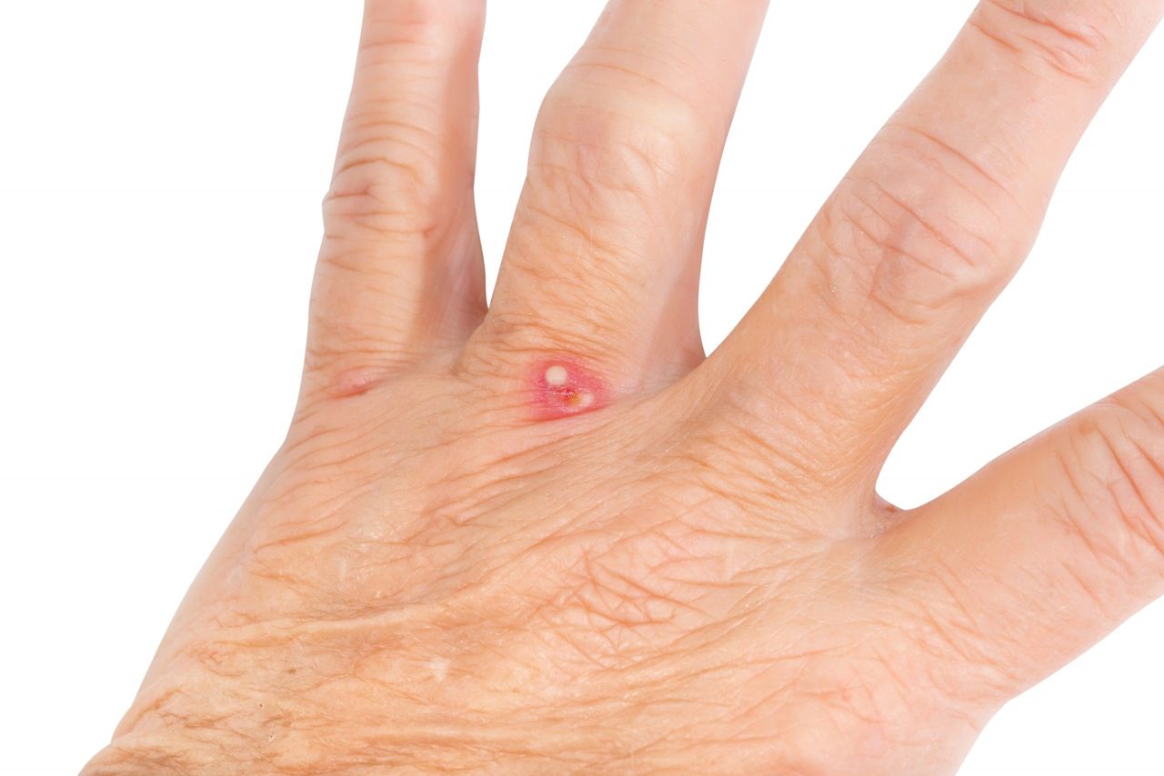Red Ant bite on a seniors hand near her fingers.RM.  rrClick here to view my other Medical images  a.m.