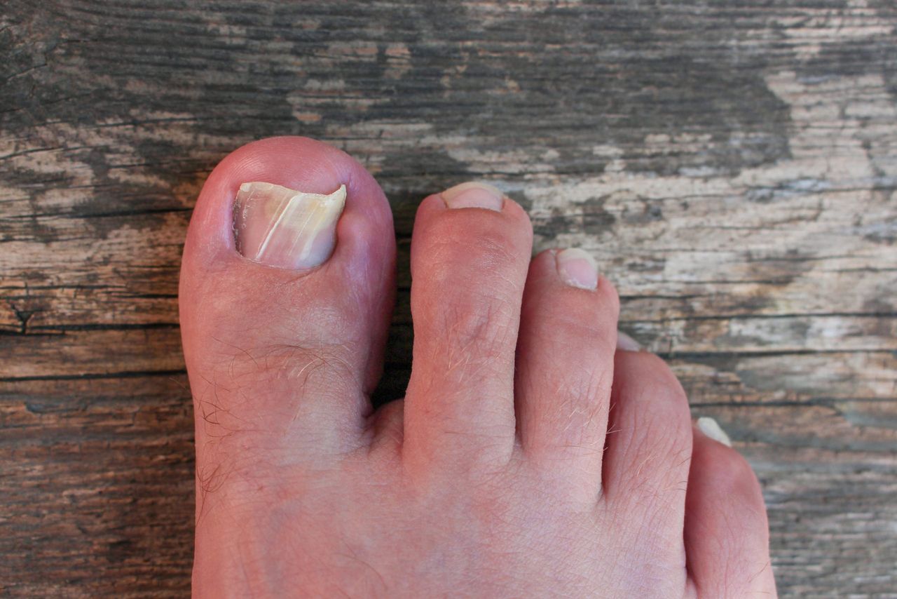 Damaged toenail. Top view.