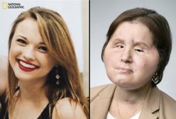 "Dostałam drugie życie". National Geographic nakręcił film o 18-latce, która straciła twarz