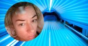 Uzależnienie od solarium. Została oszpecona, teraz apeluje do innych