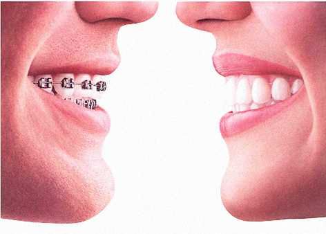 Estetyczne aparaty ortodontyczne