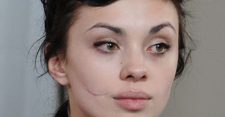 Anna Koryto: "Moja blizna to było show"