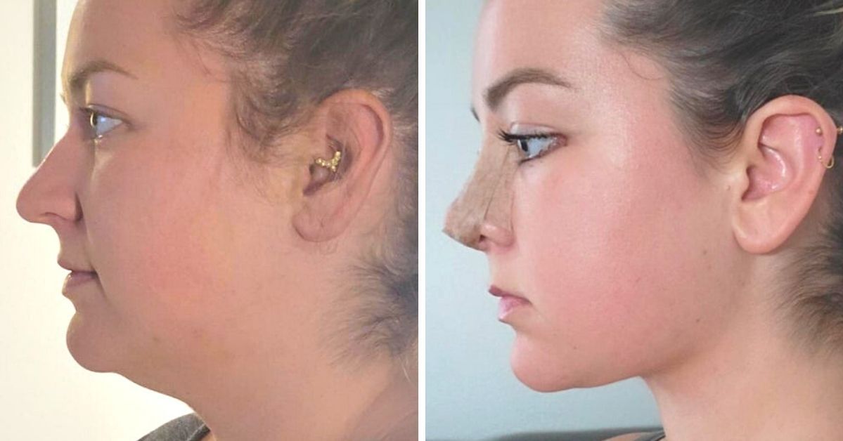 15 Ladies Who Decided to Have Plastic Surgery and Started a New Life