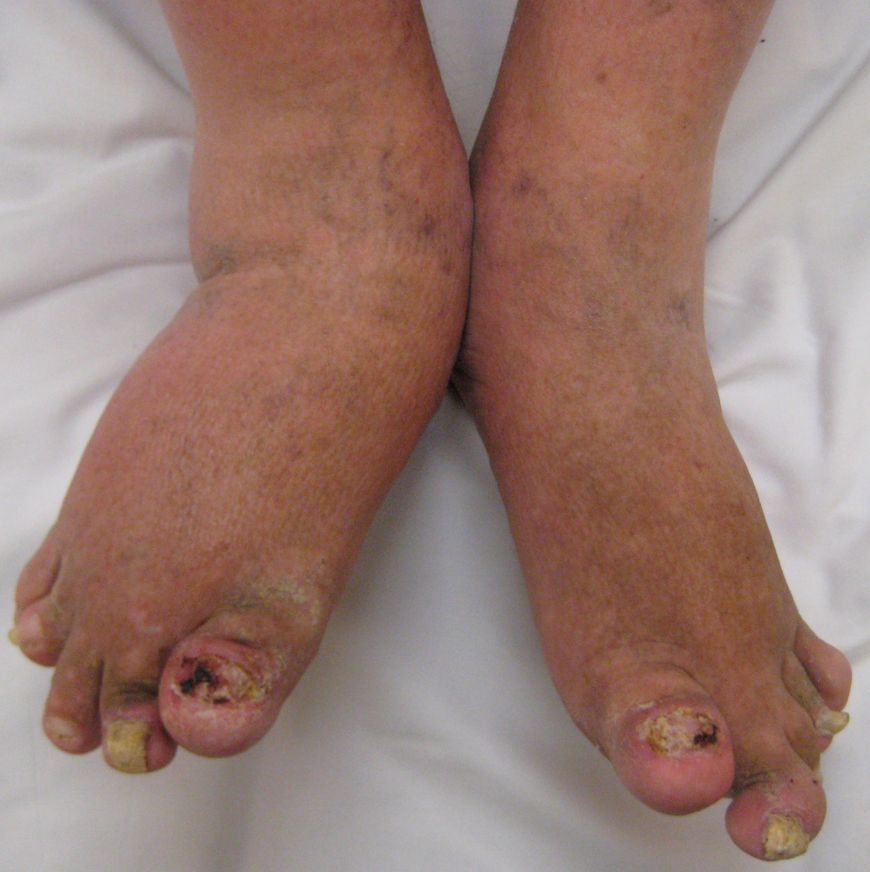 Zmienione chorobowo stopy osoby z łuszczycą stawów