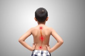 Skolioza - objawy i podział skoliozy, przyczyny, leczenie skoliozy u dzieci
