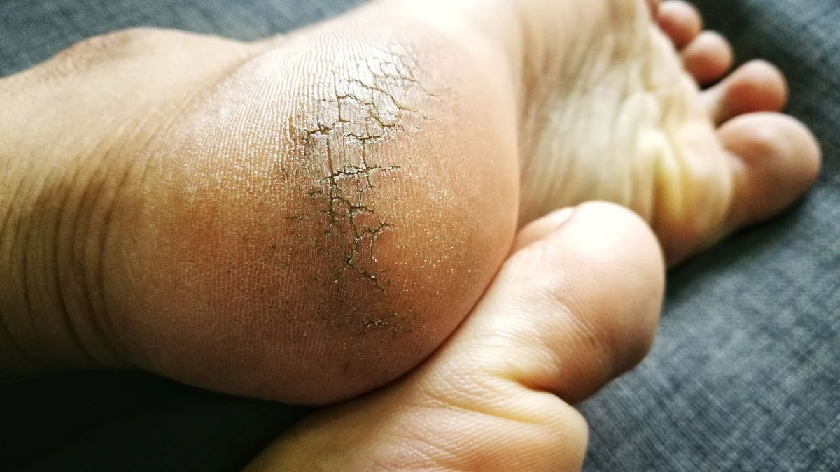 Popękane pięty mogą być objawem choroby