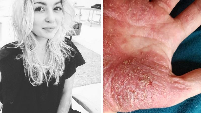 Giorgia Lanuzza po utracie ojca doznała licznych plam na ciele