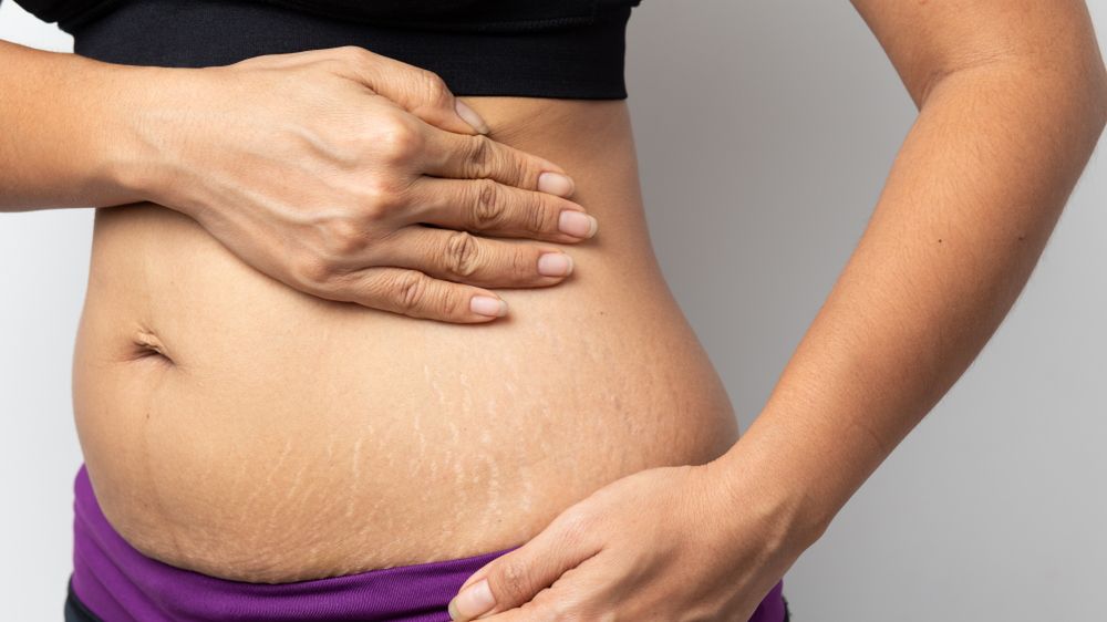 Rozstępy – co zrobić, by ich uniknąć?