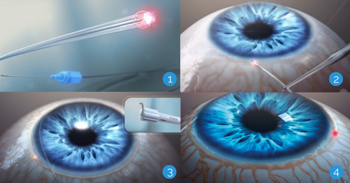 Leczenie jaskry - ABiC przywraca naturalny system odpływu oka, obniżając ciśnienie wewnątrzgałkowe