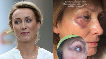 Anna Kalczyńska miała wypadek na nartach. Pokazała zdjęcie siniaków: "RAZ SIĘ ŻYJE. DO WESELA SIĘ ZAGOI"