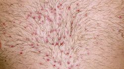 Zakażenie Omikronem widać na skórze. Nie lekceważ tego objawu COVID-19