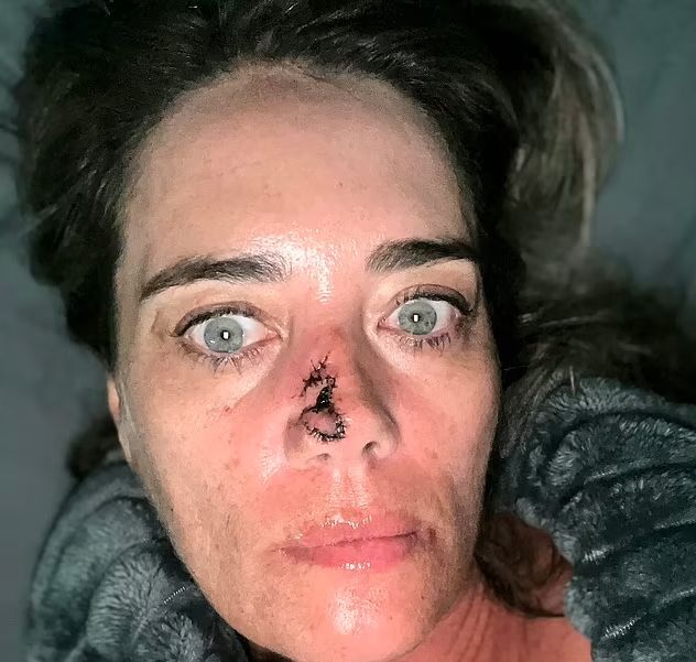 Michelle nie przypuszczała, że niewinna zmiana okaże się nowotworem